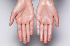 How To Stop Sweaty Hands: 12 Tips, Remedies, and Treatments